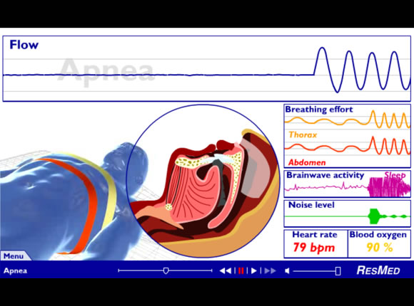 Resmed, on-line product information
